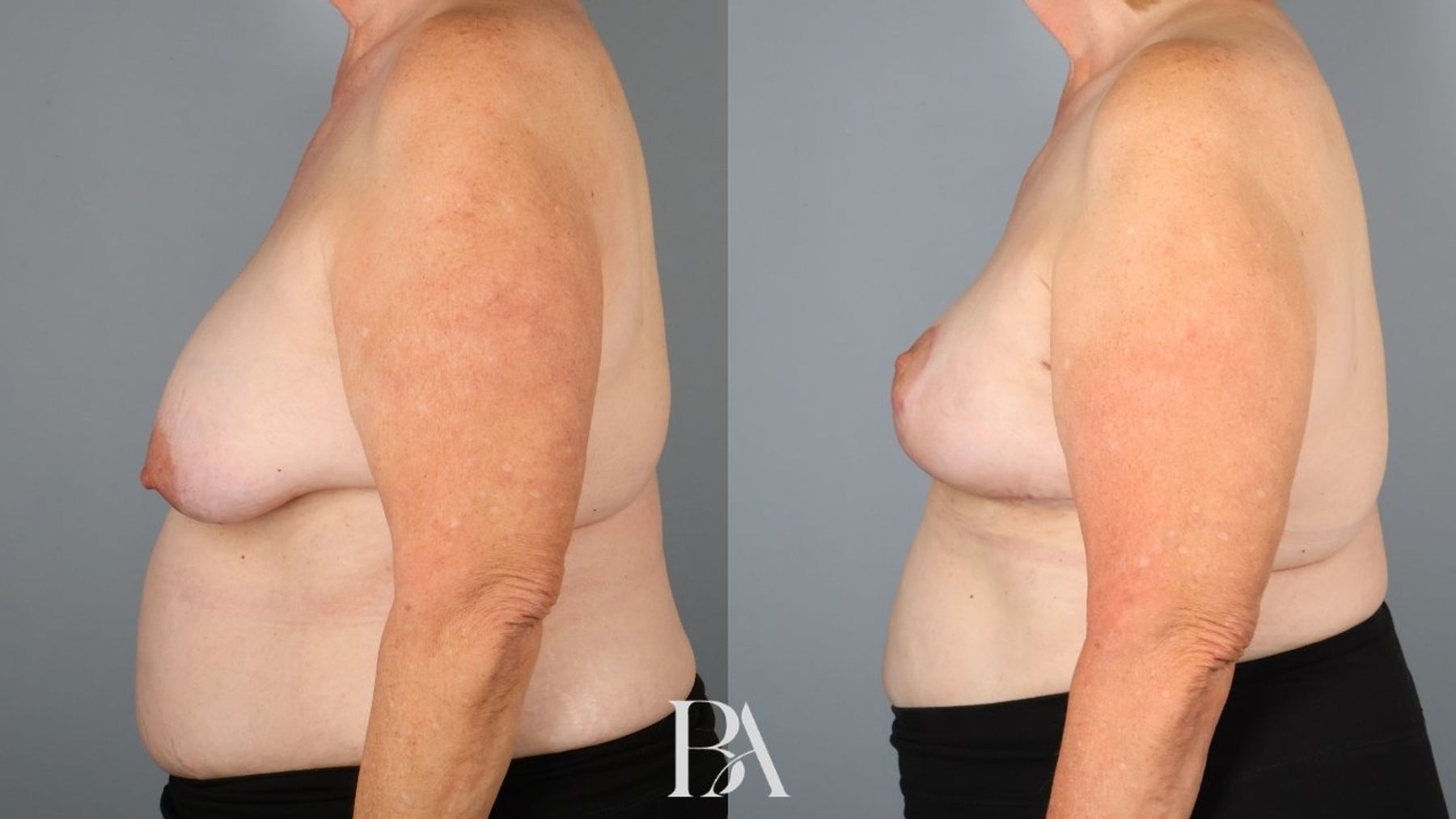 Oncoplastic Reduction before and after — side view, Dr. Beina Azadgoli, Beverly Hills