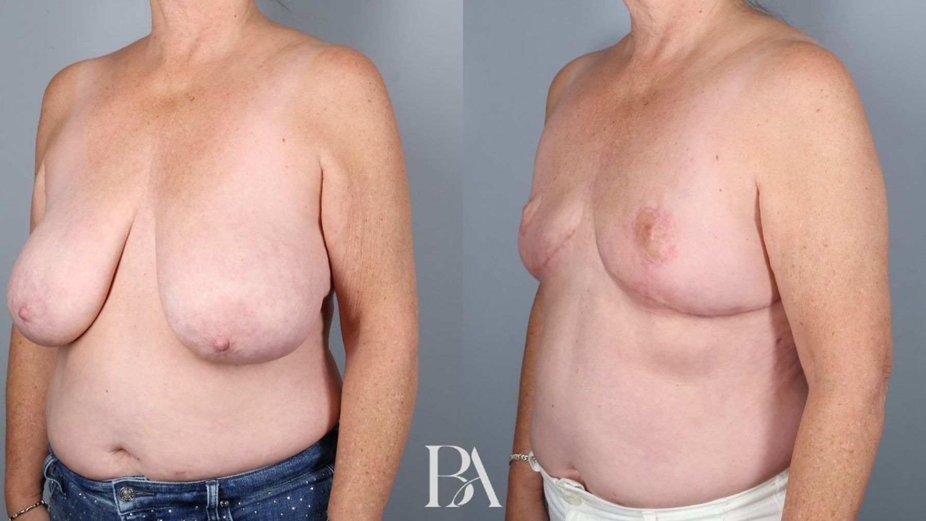 SWIM Flap Reconstruction before and after — three-quarter view, Dr. Beina Azadgoli, Beverly Hills