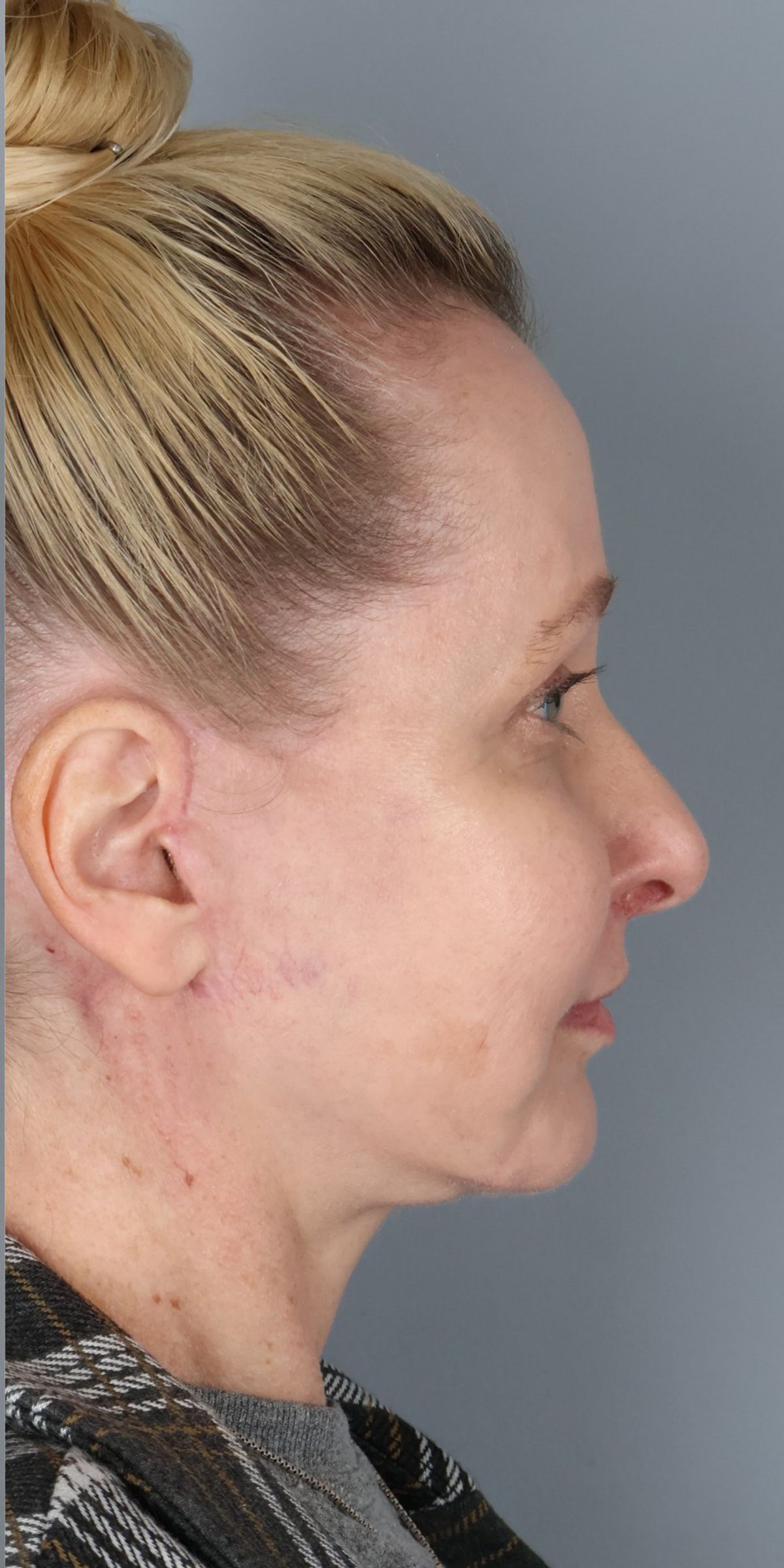 Face/neck lift after — side view, Dr. Beina Azadgoli, Beverly Hills