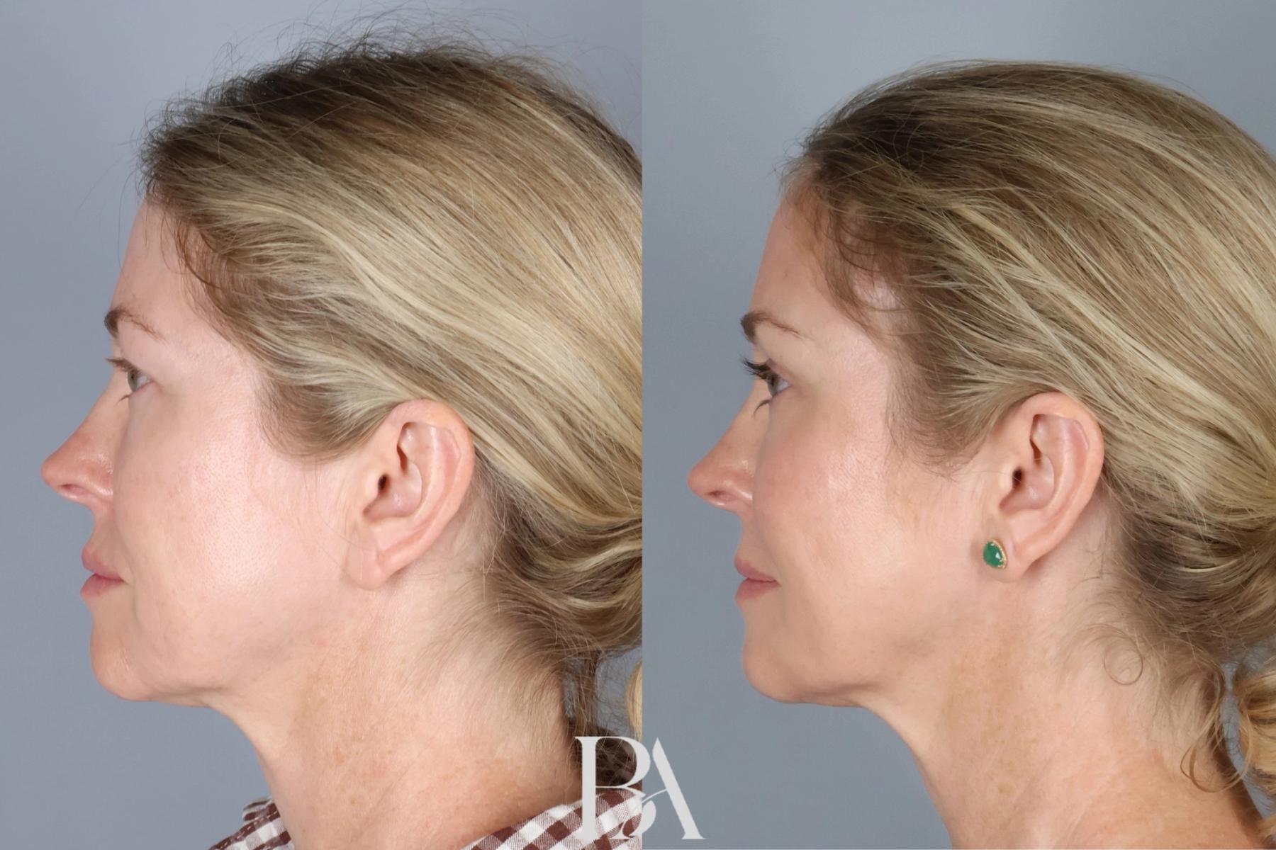 Upper Blepharoplasty before and after — side view, Dr. Beina Azadgoli, Beverly Hills