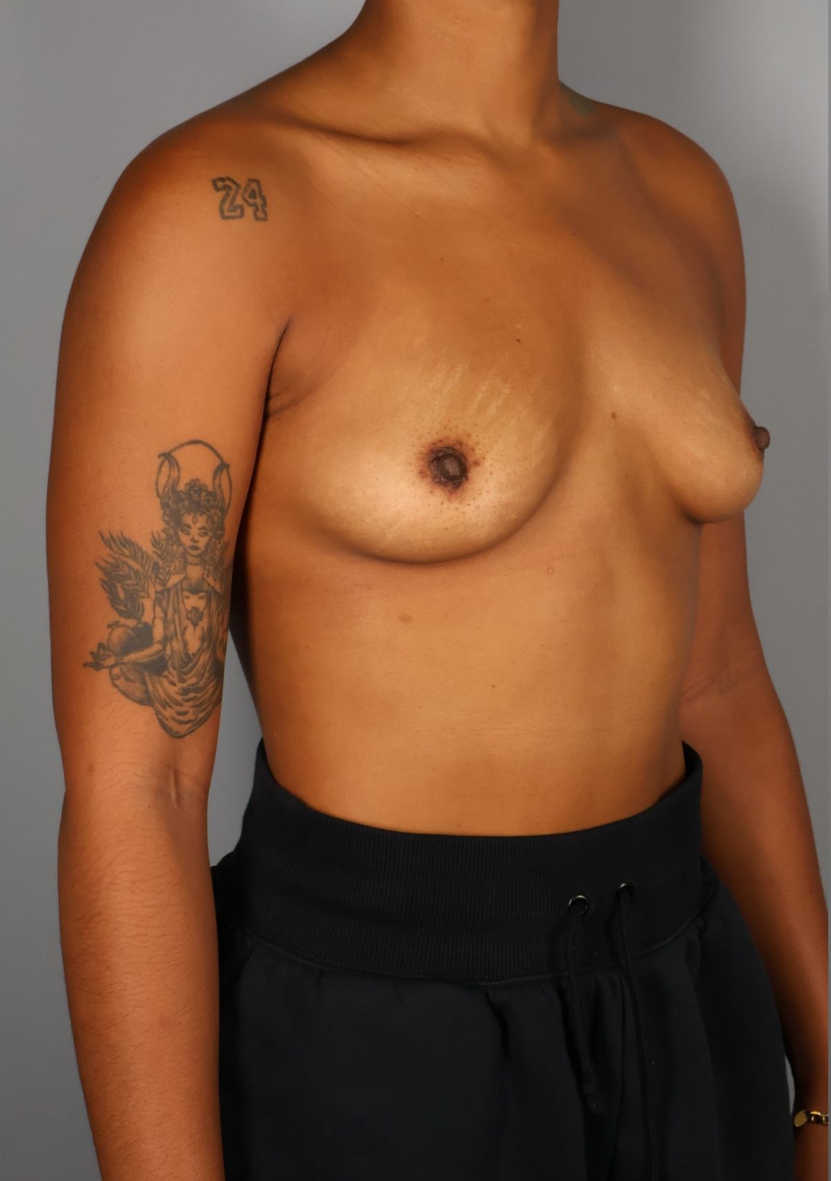 Breast augmentation before — side view, Dr. Beina Azadgoli, Beverly Hills