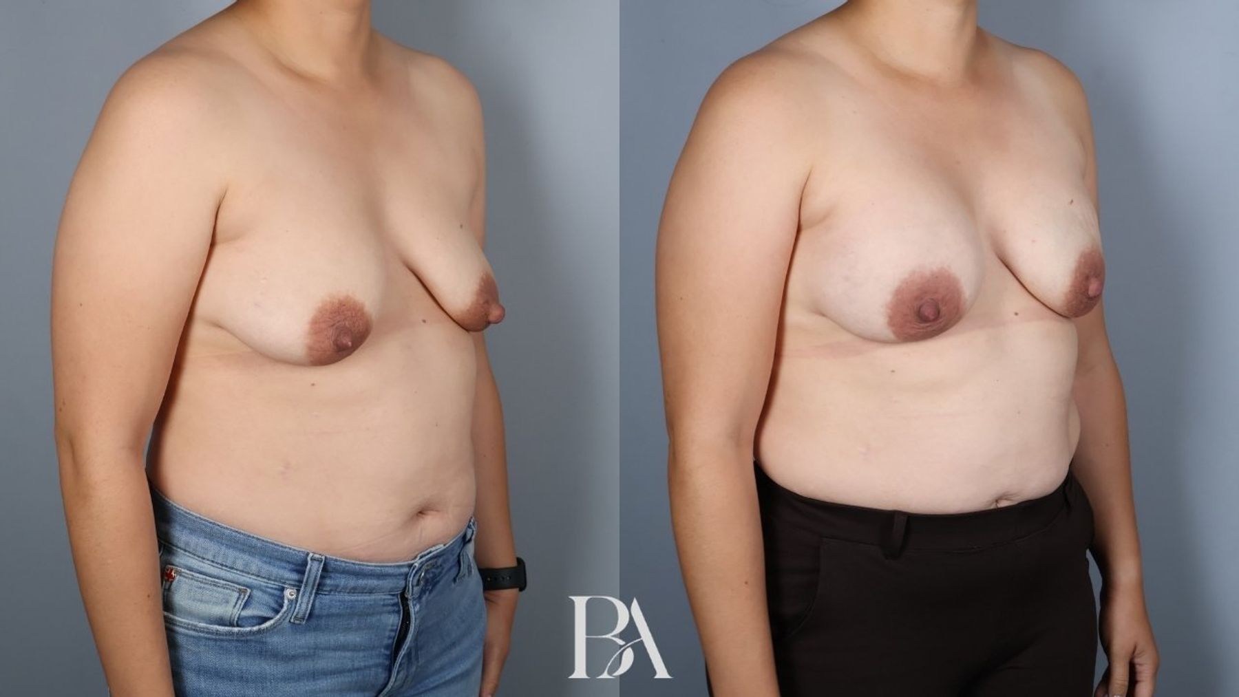 Direct-to-Implant Reconstruction before and after — oblique view, Dr. Beina Azadgoli, Beverly Hills