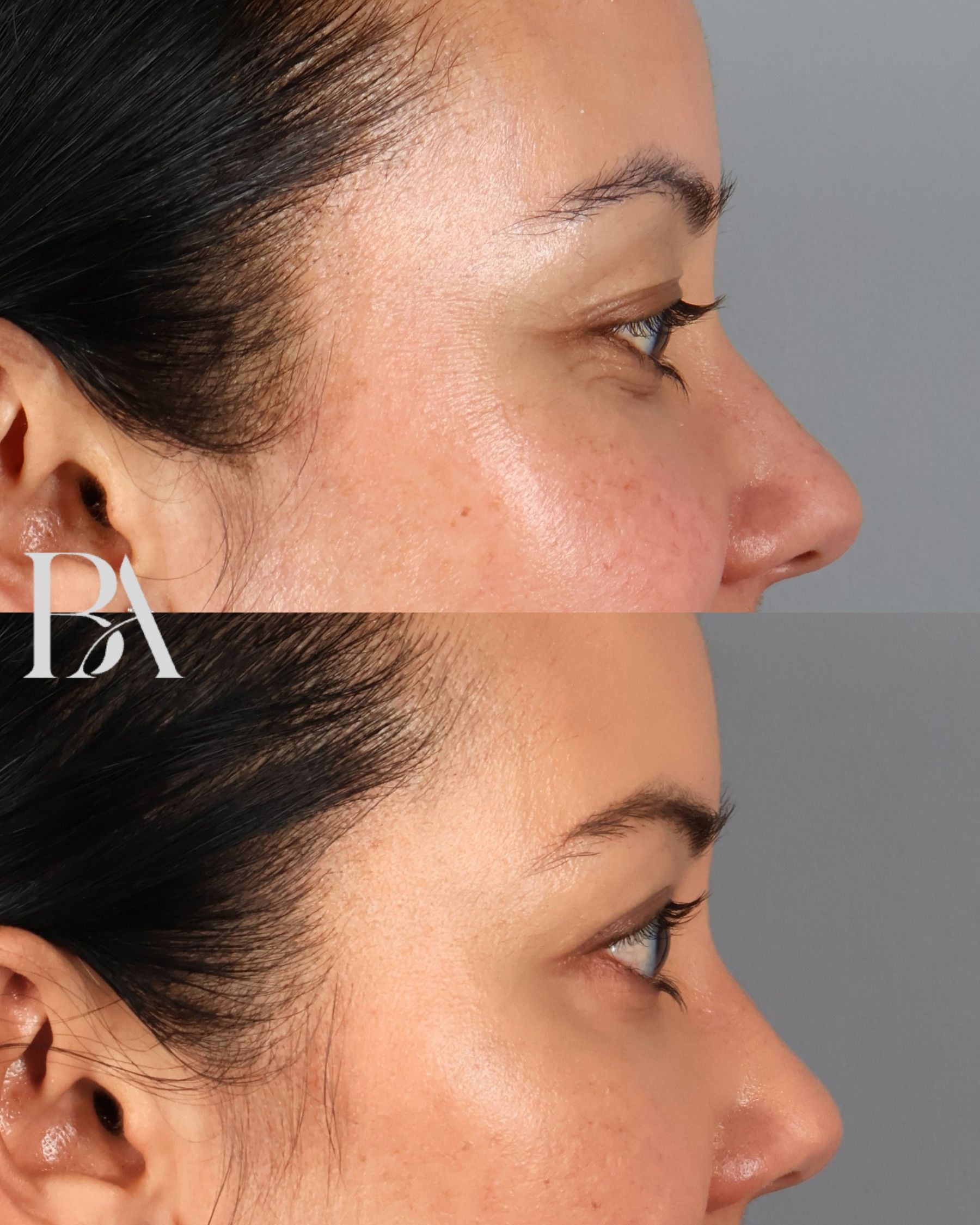 Upper Blepharoplasty before and after — side view, Dr. Beina Azadgoli, Beverly Hills