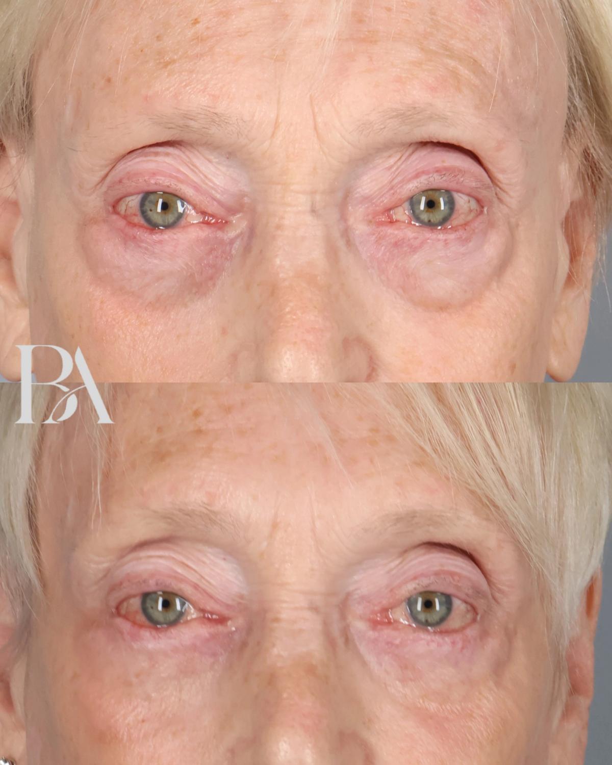 Lower Blepharoplasty before and after — front view, Dr. Beina Azadgoli, Beverly Hills