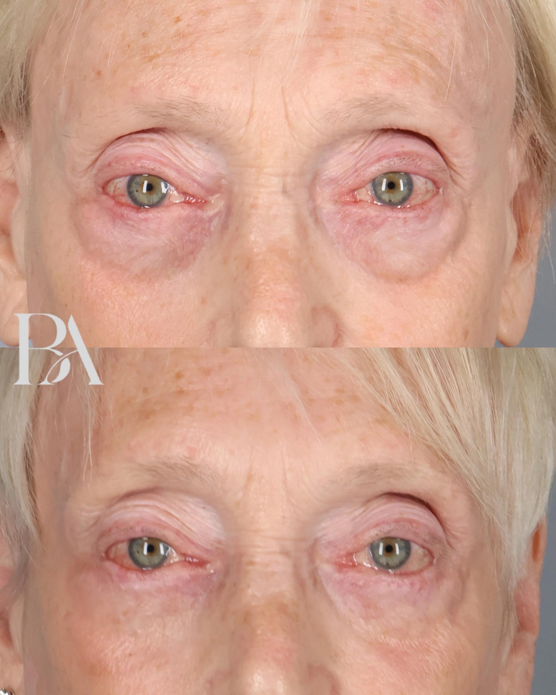 Lower Blepharoplasty before and after — front view, Dr. Beina Azadgoli, Beverly Hills