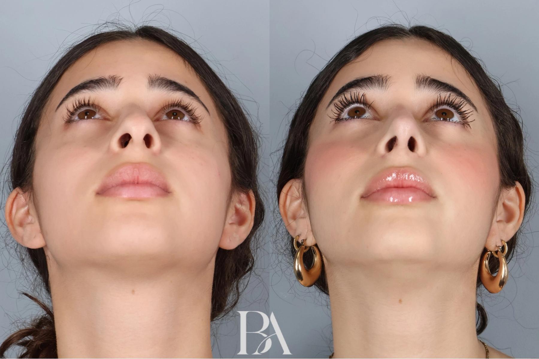 Rhinoplasty before and after — detail view, Dr. Beina Azadgoli, Beverly Hills