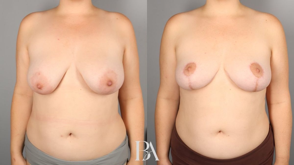 Before and after — Breast Lift (Mastopexy)