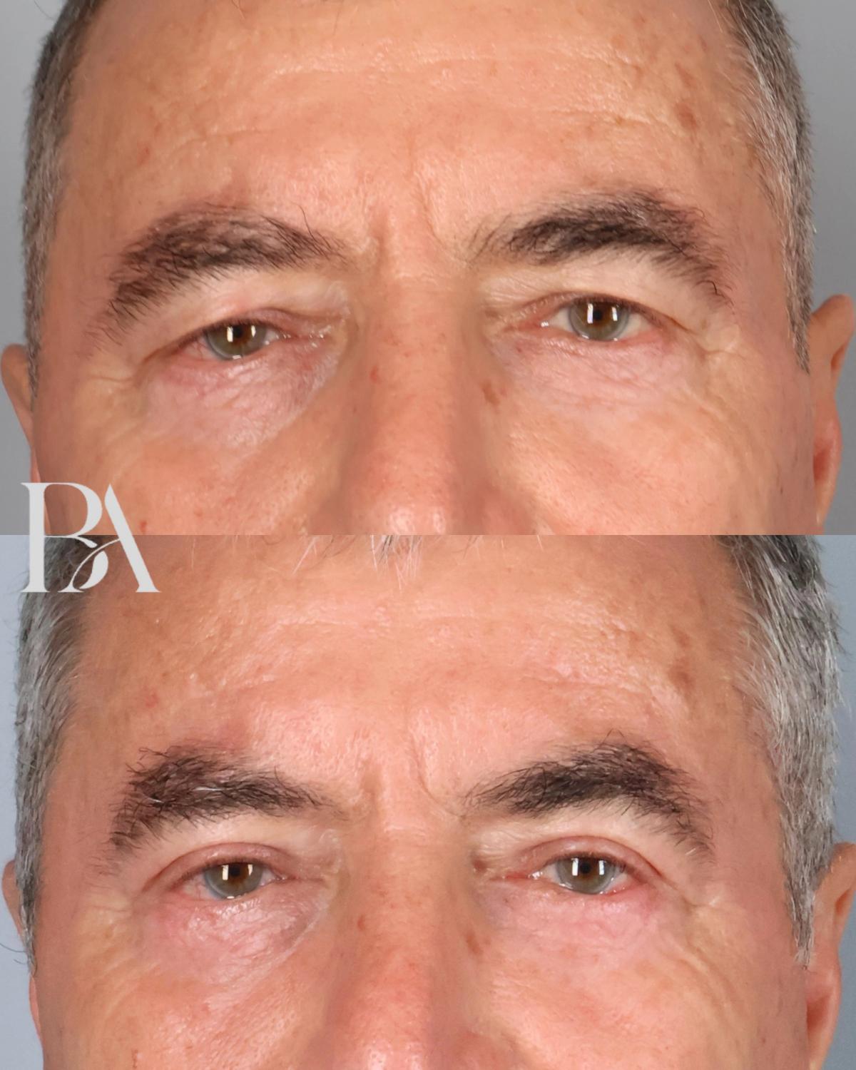 Before and after — Upper Blepharoplasty