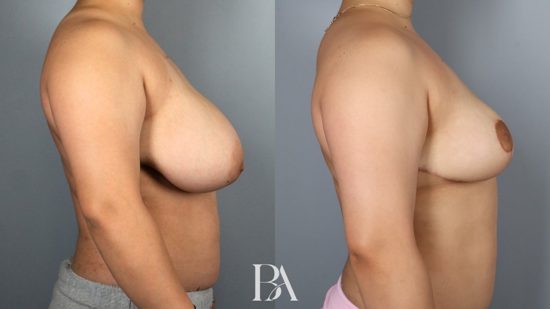 Breast reduction before and after — side view, Dr. Beina Azadgoli, Beverly Hills