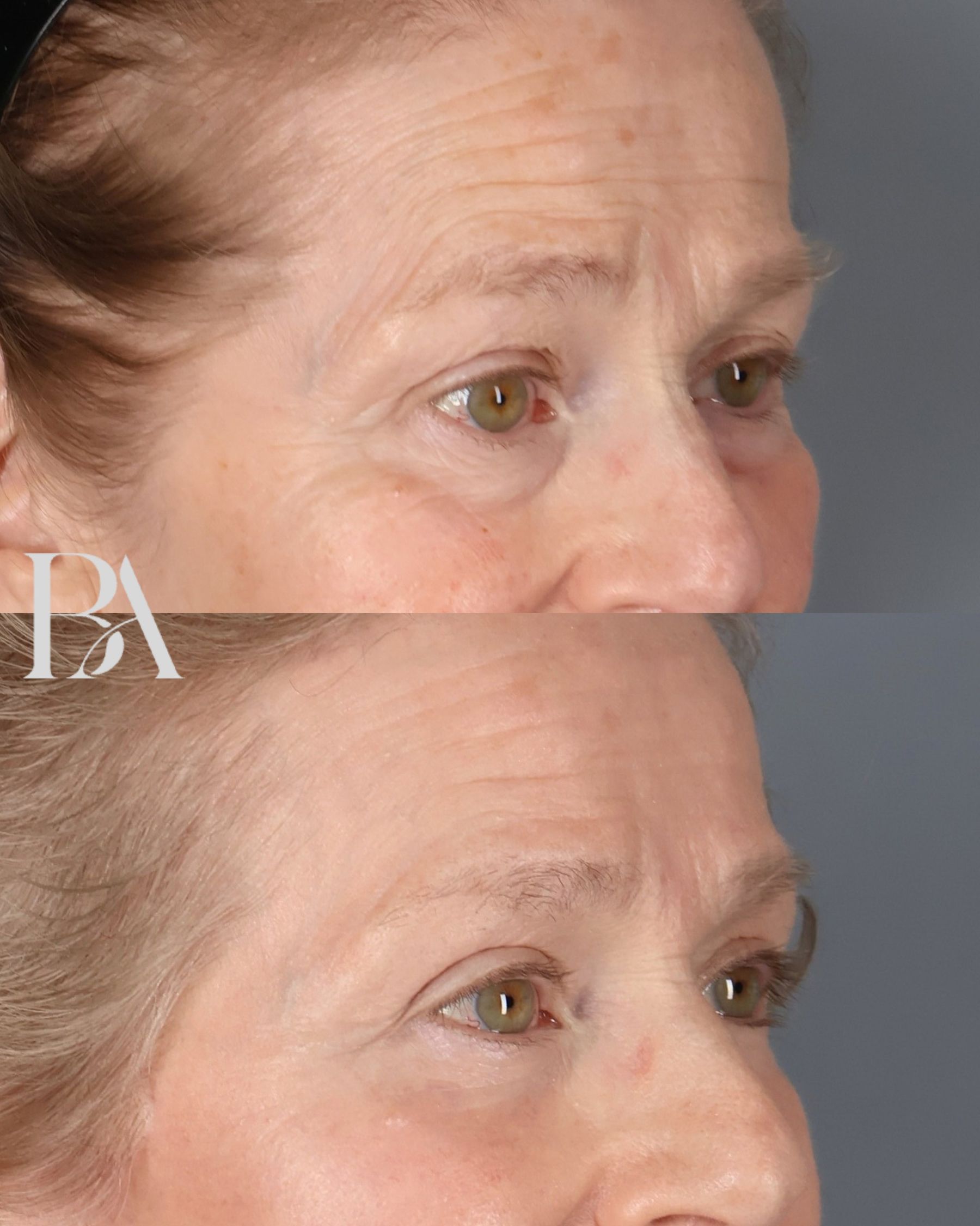 Upper Blepharoplasty before and after — three-quarter view, Dr. Beina Azadgoli, Beverly Hills