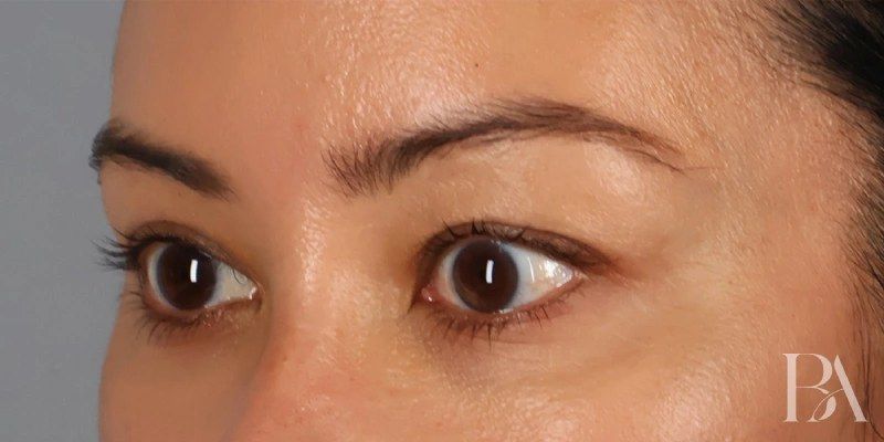 After — Upper Blepharoplasty