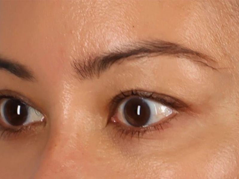 After — Upper Blepharoplasty