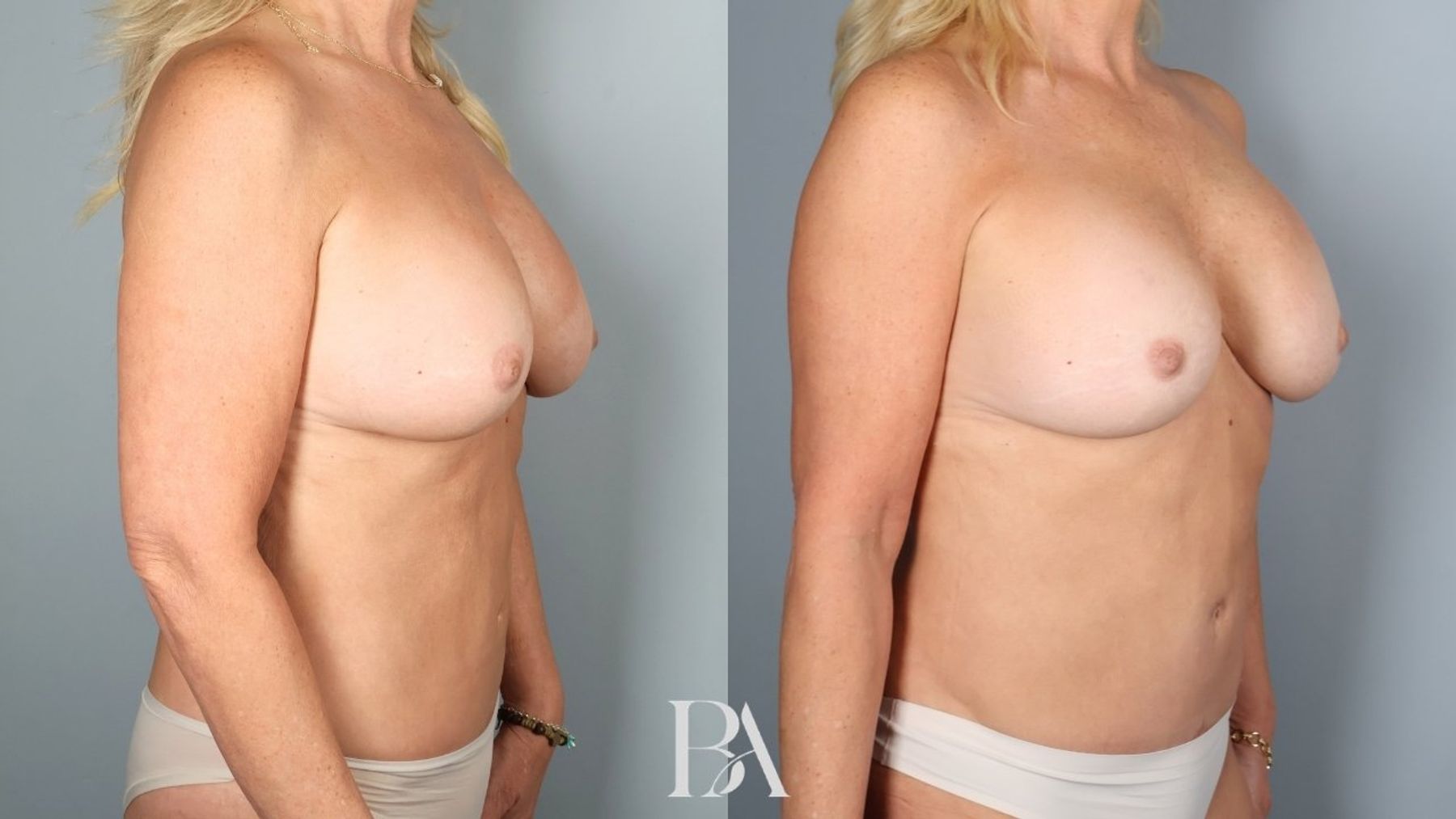 Implant Removal and Replacement before and after — oblique view, Dr. Beina Azadgoli, Beverly Hills
