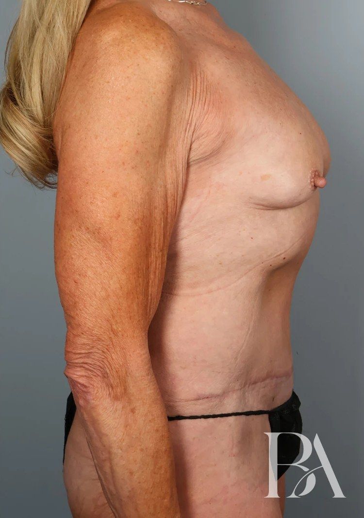 After — Tummy Tuck (Abdominoplasty)
