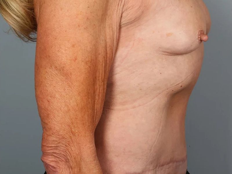 After — Tummy Tuck (Abdominoplasty)