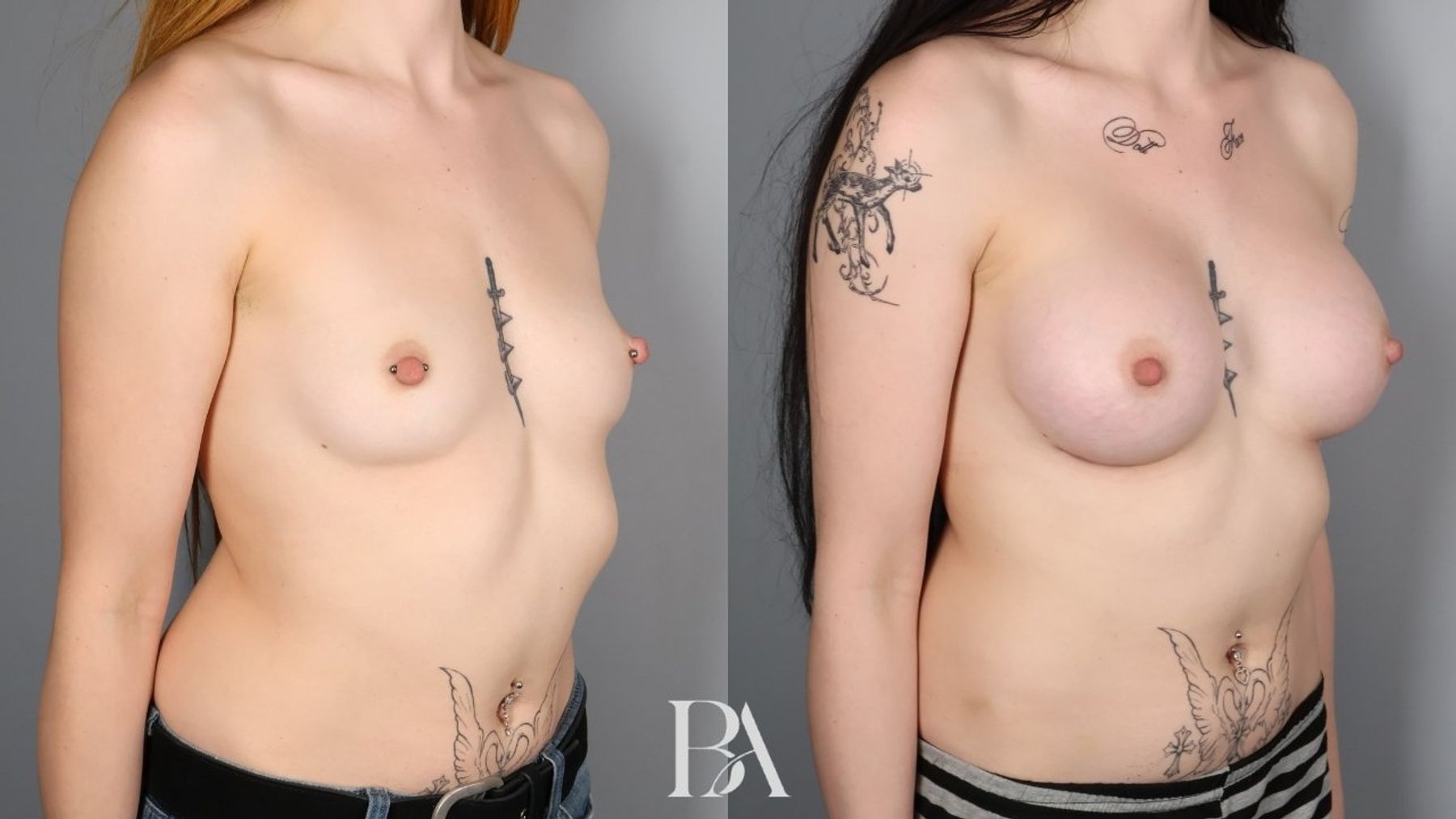 Breast augmentation before and after — oblique view, Dr. Beina Azadgoli, Beverly Hills