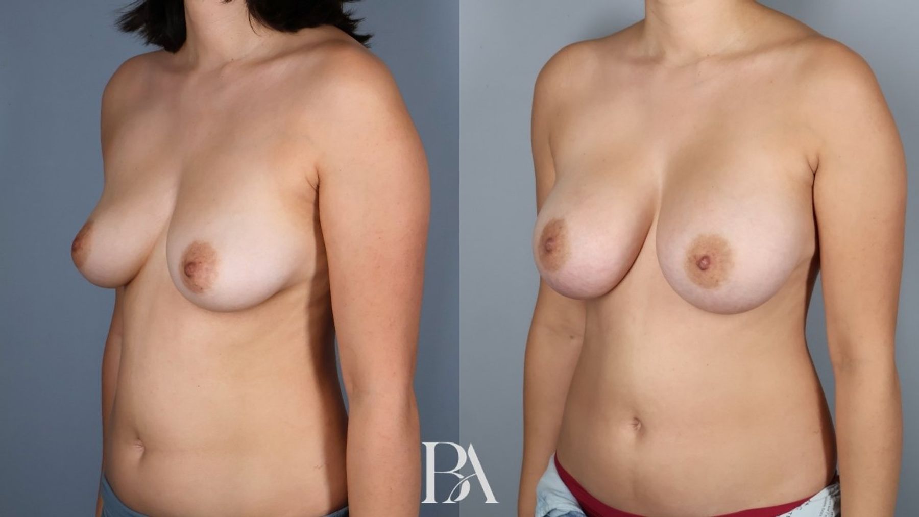 Breast augmentation before and after — three-quarter view, Dr. Beina Azadgoli, Beverly Hills