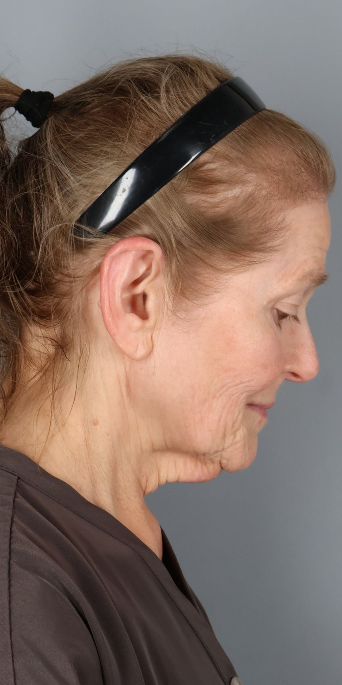 Face/neck lift before — detail view, Dr. Beina Azadgoli, Beverly Hills