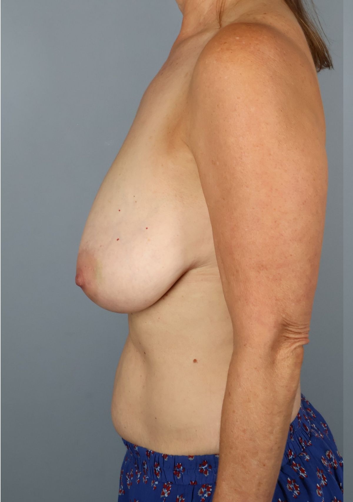 Breast reduction before — side view, Dr. Beina Azadgoli, Beverly Hills