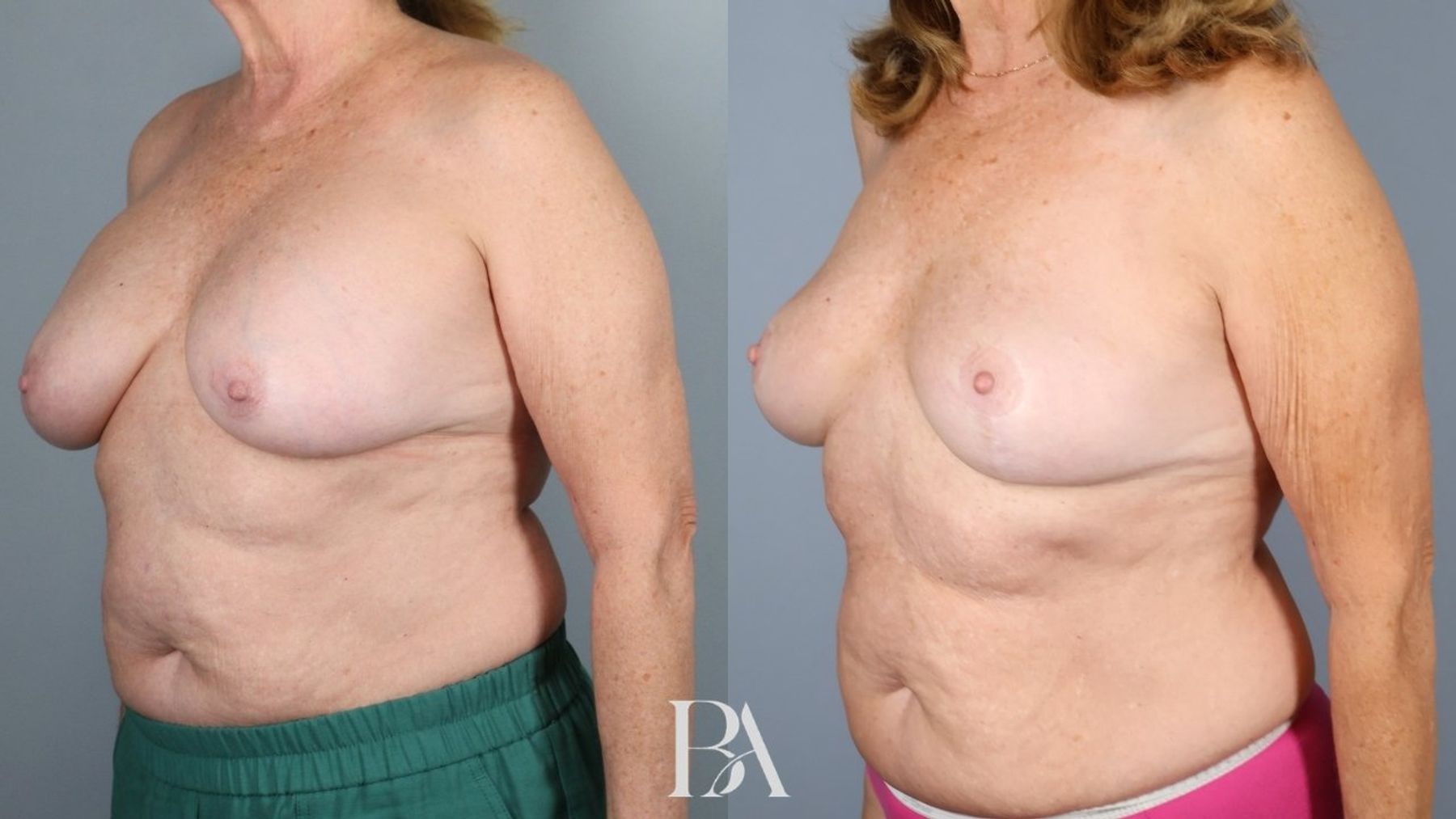 Breast implant removal before and after — three-quarter view, Dr. Beina Azadgoli, Beverly Hills