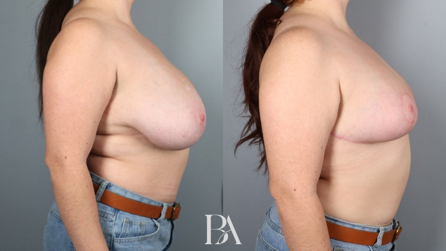Breast reduction before and after — side view, Dr. Beina Azadgoli, Beverly Hills