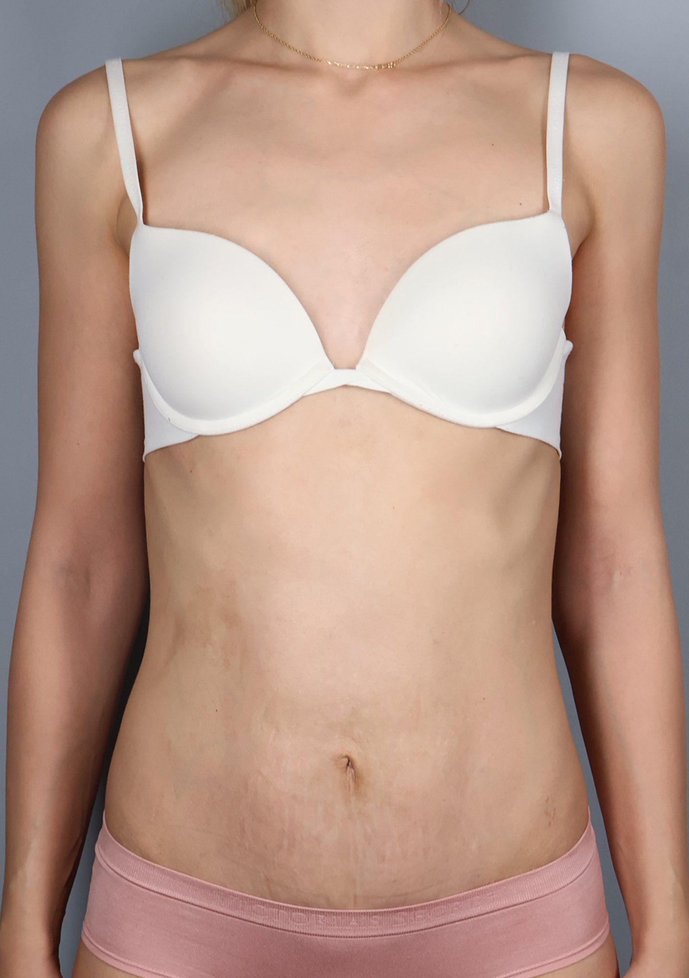 After — Tummy Tuck (Abdominoplasty)