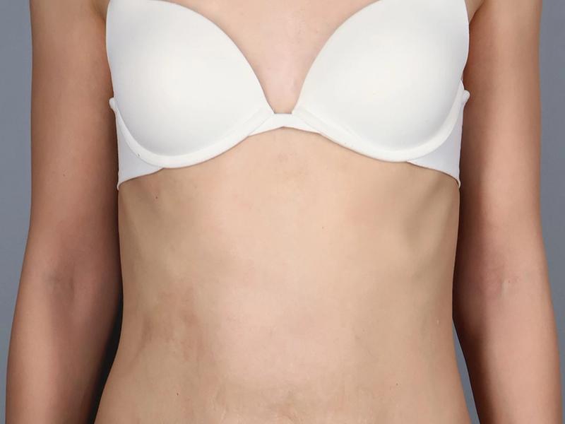 After — Tummy Tuck (Abdominoplasty)