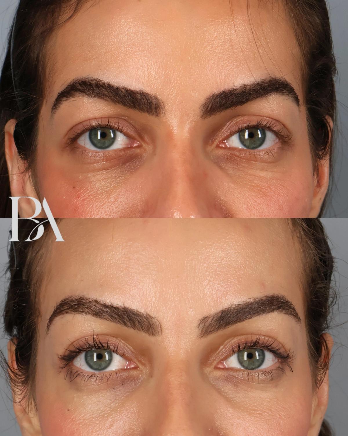 Before and after — Upper Blepharoplasty