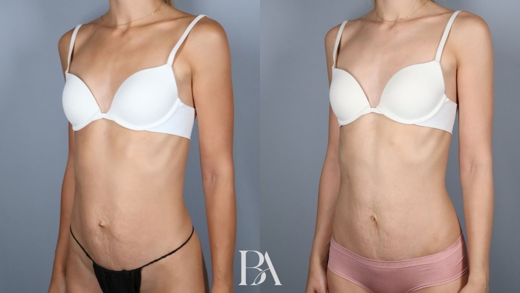 Tummy tuck before and after — three-quarter view, Dr. Beina Azadgoli, Beverly Hills