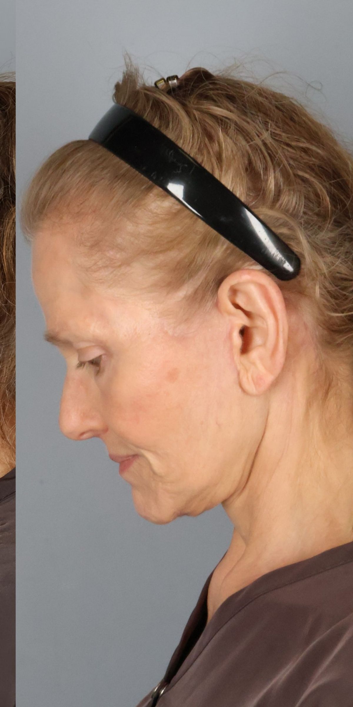 Face/neck lift after — detail view, Dr. Beina Azadgoli, Beverly Hills