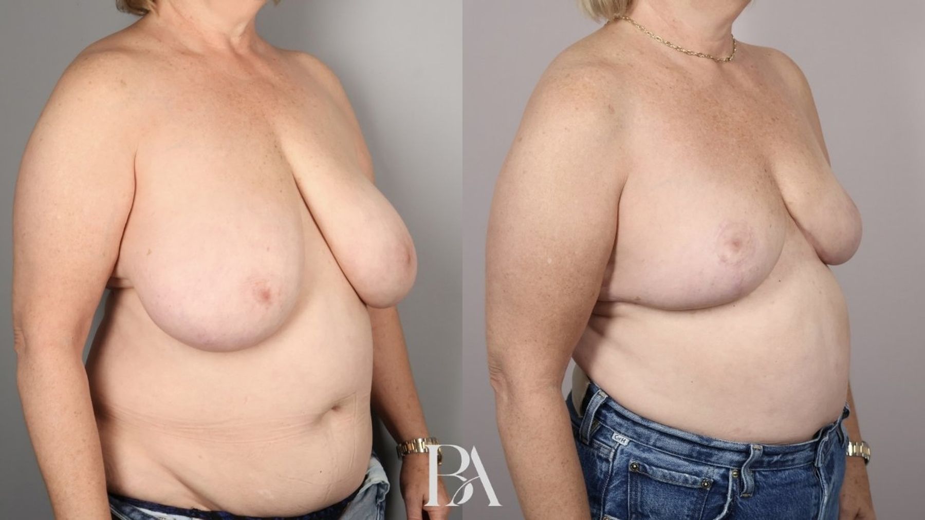 Breast reduction before and after — oblique view, Dr. Beina Azadgoli, Beverly Hills