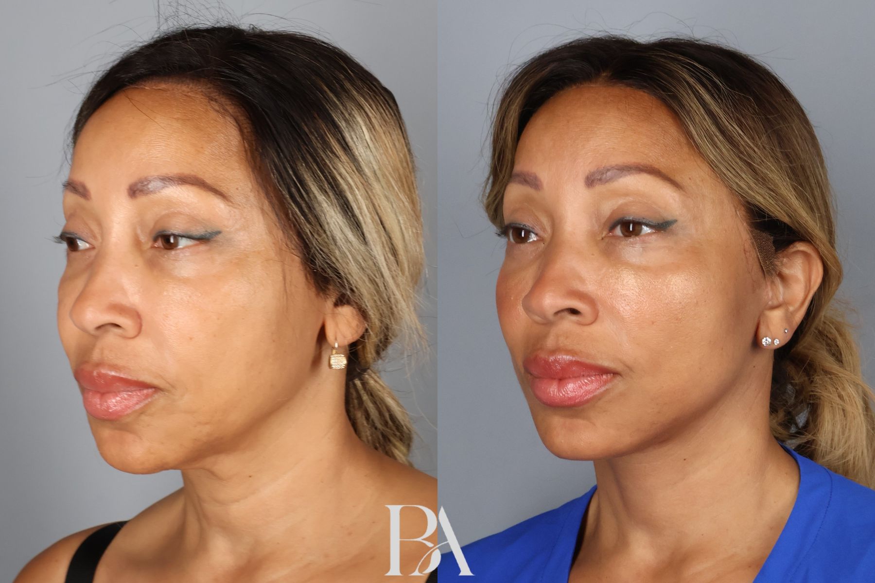 Face/Neck Lift before and after — three-quarter view, Dr. Beina Azadgoli, Beverly Hills
