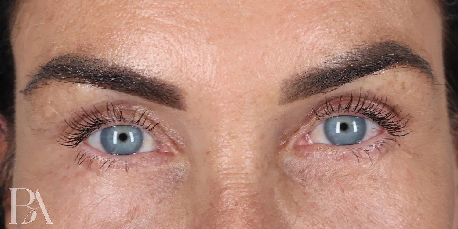 After — Upper Blepharoplasty