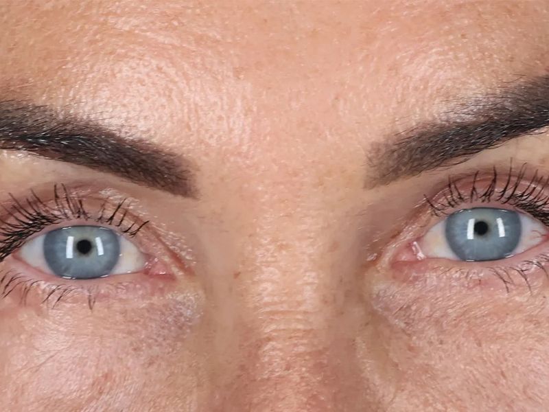 After — Upper Blepharoplasty