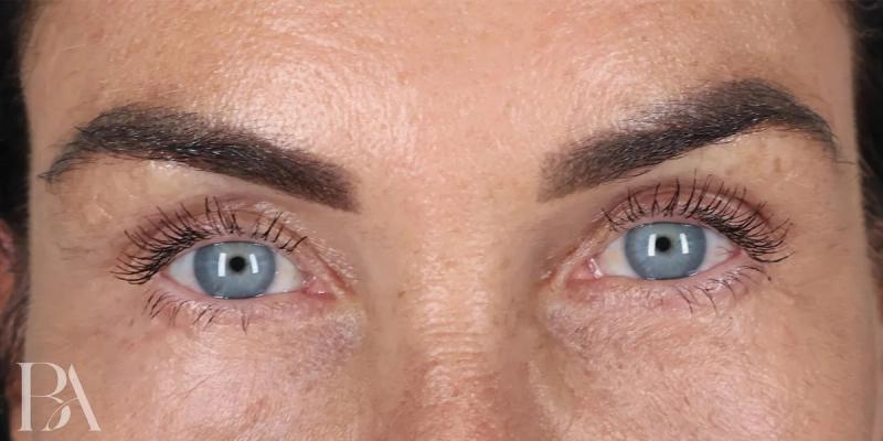 After — Upper Blepharoplasty