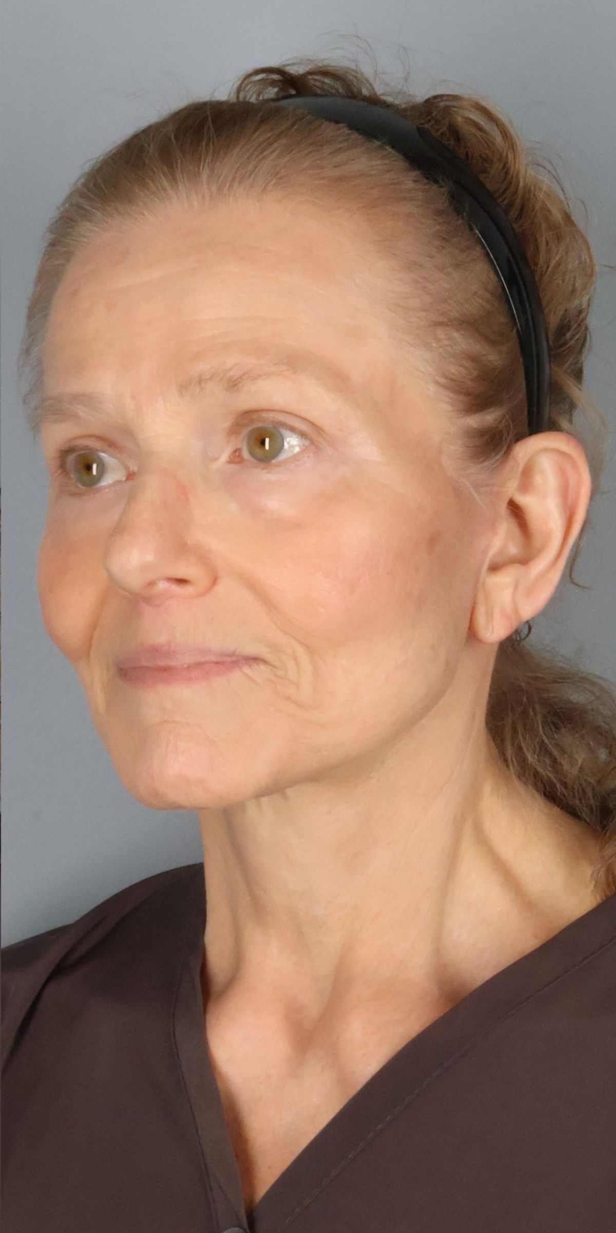 Face/neck lift after — three-quarter view, Dr. Beina Azadgoli, Beverly Hills