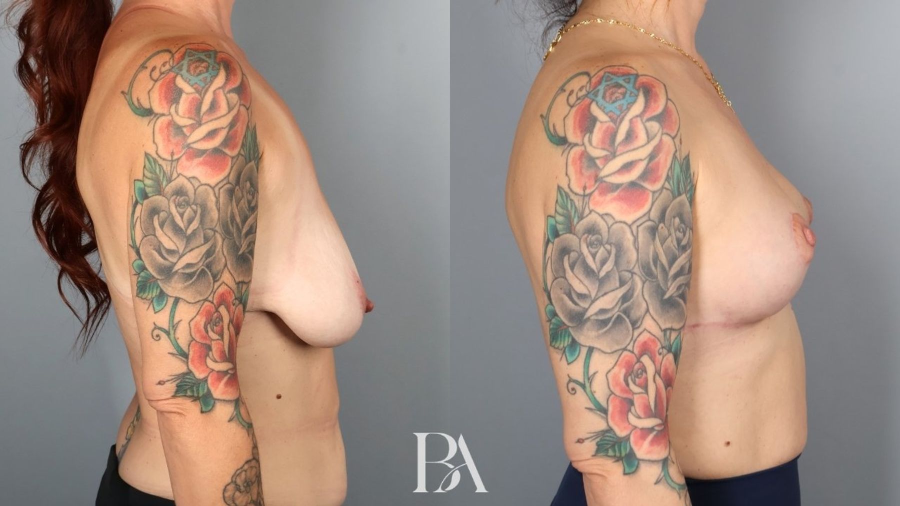 Breast lift before and after — side view, Dr. Beina Azadgoli, Beverly Hills