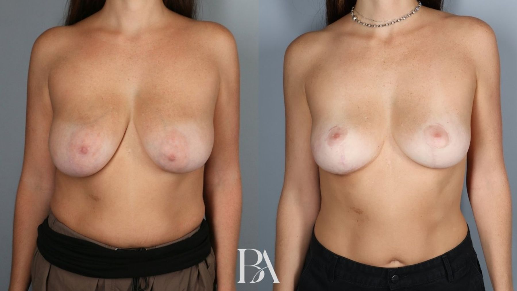 Breast lift before and after — front view, Dr. Beina Azadgoli, Beverly Hills