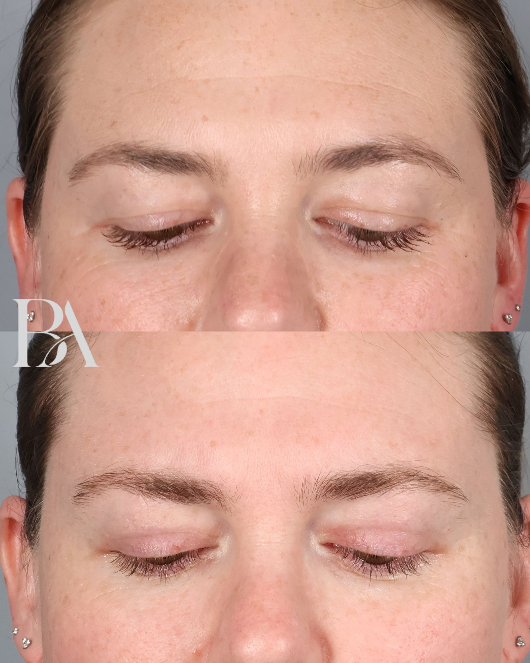 Upper Blepharoplasty before and after — detail view, Dr. Beina Azadgoli, Beverly Hills