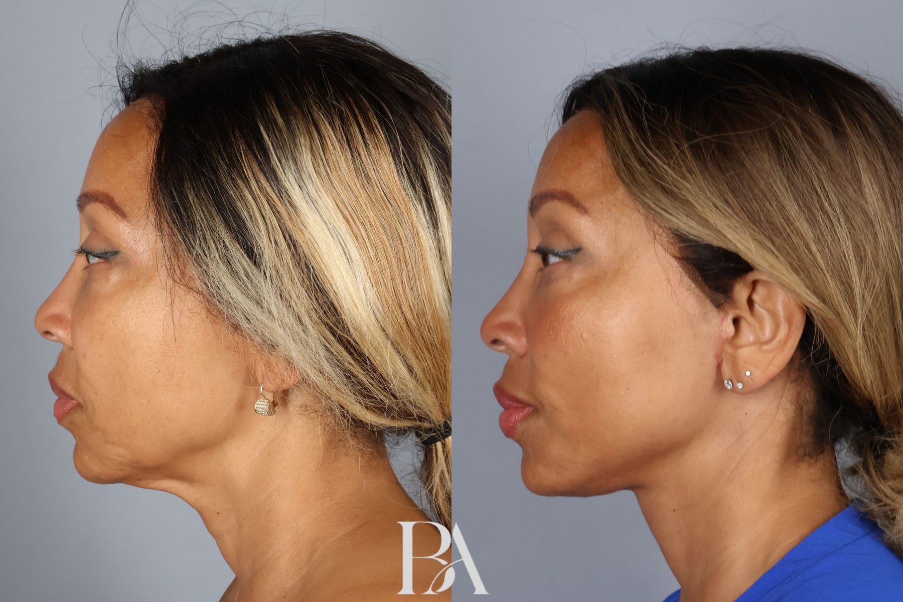 Face/Neck Lift before and after — detail view, Dr. Beina Azadgoli, Beverly Hills