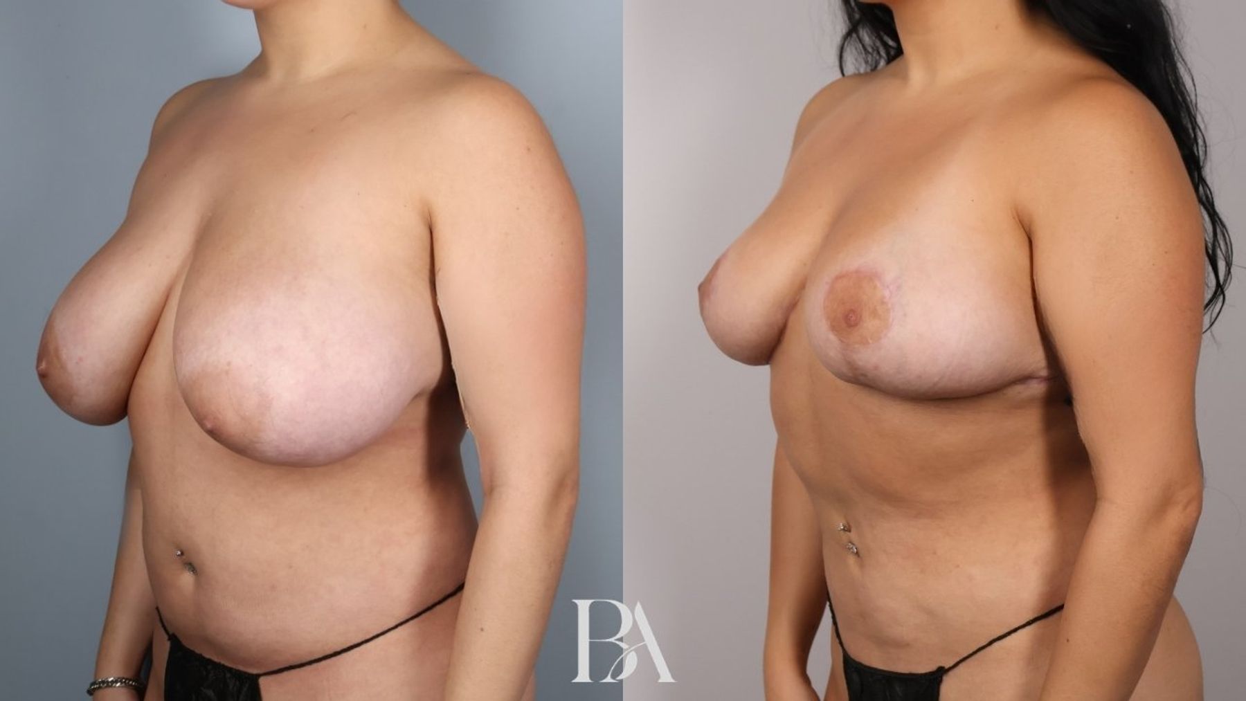 Breast reduction before and after — three-quarter view, Dr. Beina Azadgoli, Beverly Hills