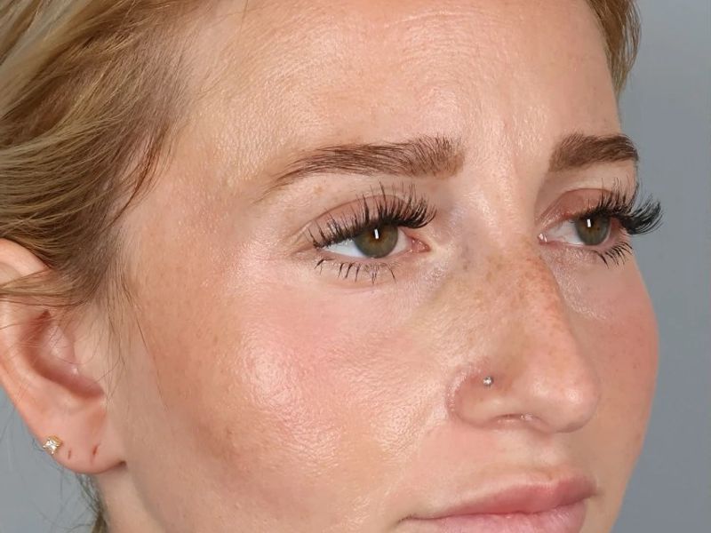 Before — Rhinoplasty