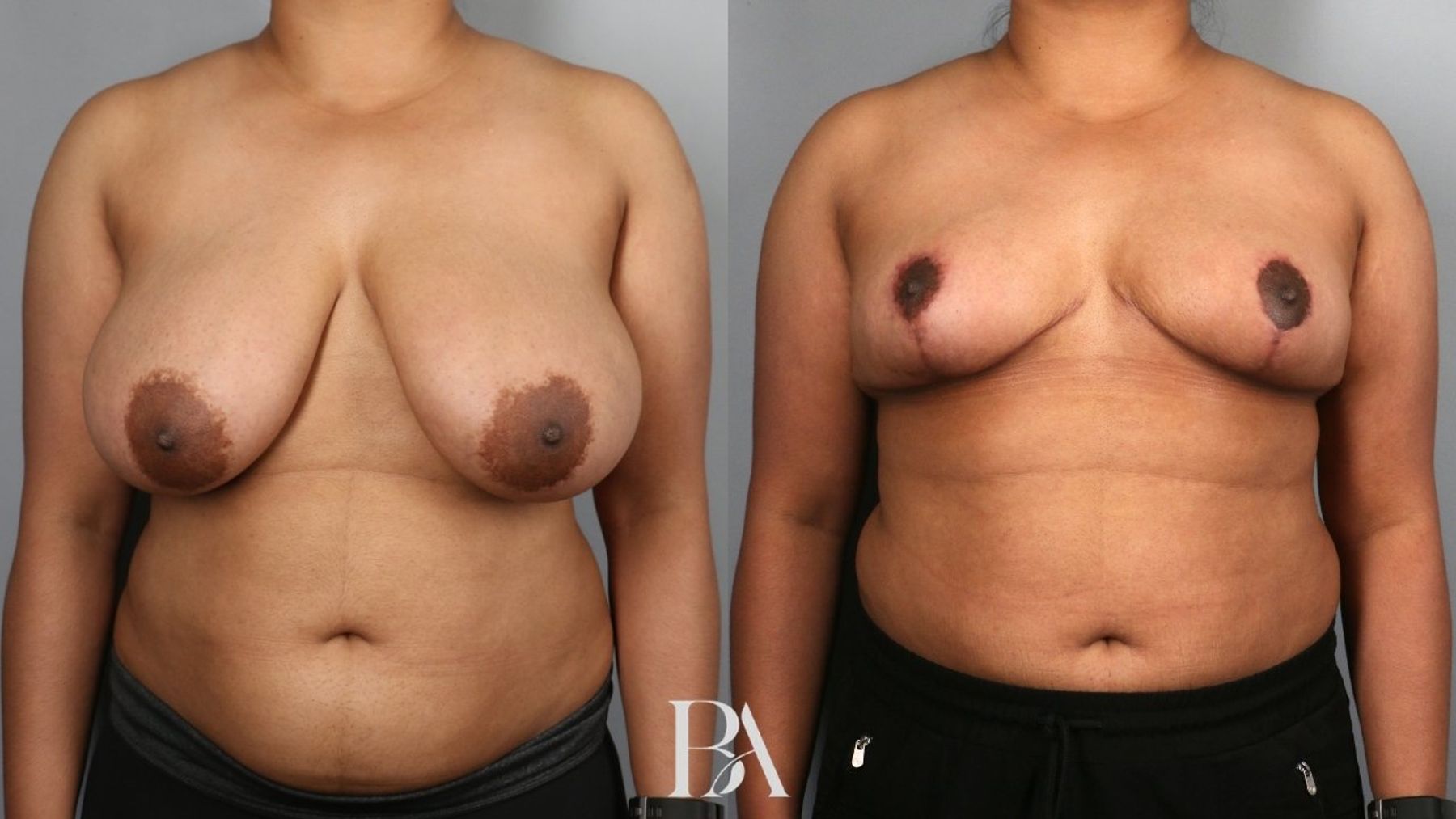Breast reduction before and after — front view, Dr. Beina Azadgoli, Beverly Hills
