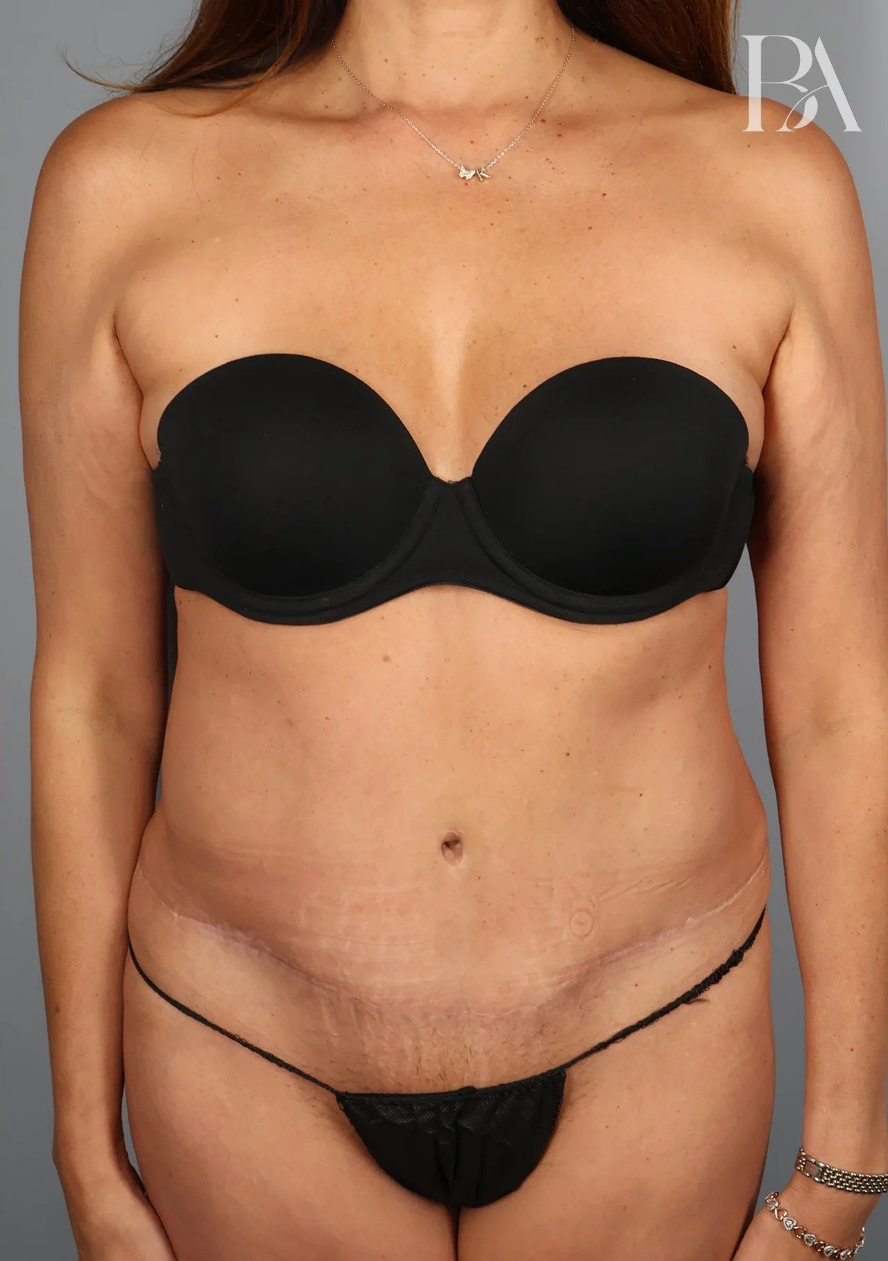 After — Tummy Tuck (Abdominoplasty)