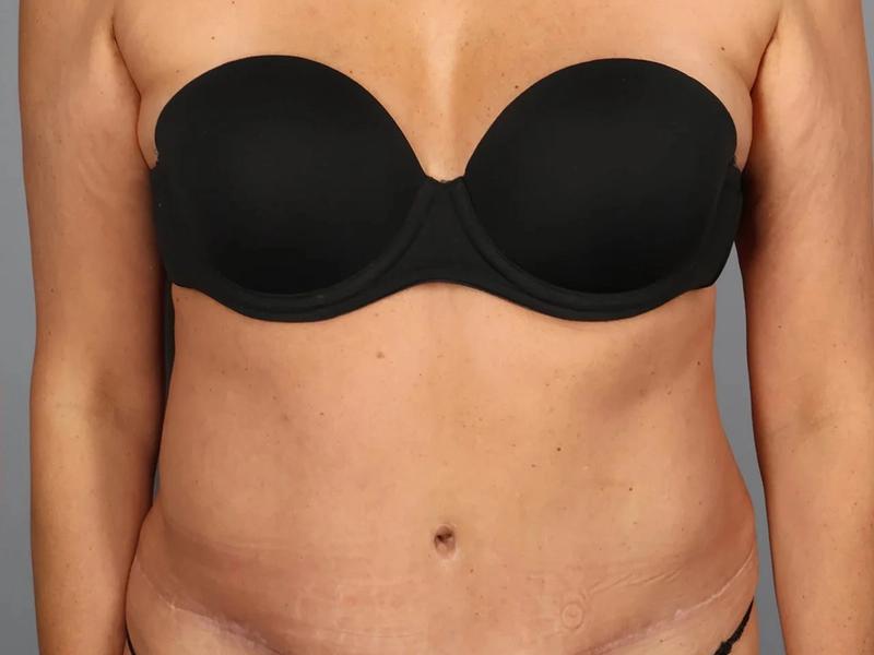 After — Tummy Tuck (Abdominoplasty)