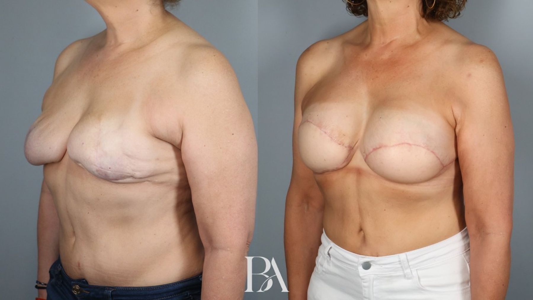 Breast Reconstruction Revision before and after — three-quarter view, Dr. Beina Azadgoli, Beverly Hills