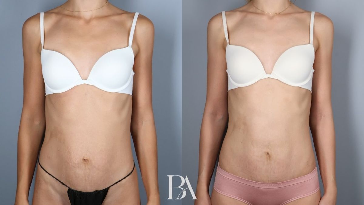Before and after — Tummy Tuck (Abdominoplasty)