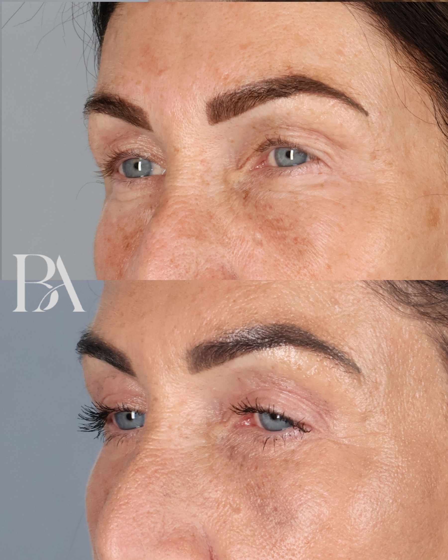 Upper Blepharoplasty before and after — three-quarter view, Dr. Beina Azadgoli, Beverly Hills