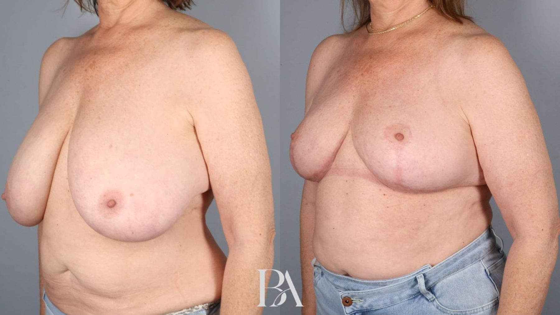 Breast reduction before and after — three-quarter view, Dr. Beina Azadgoli, Beverly Hills