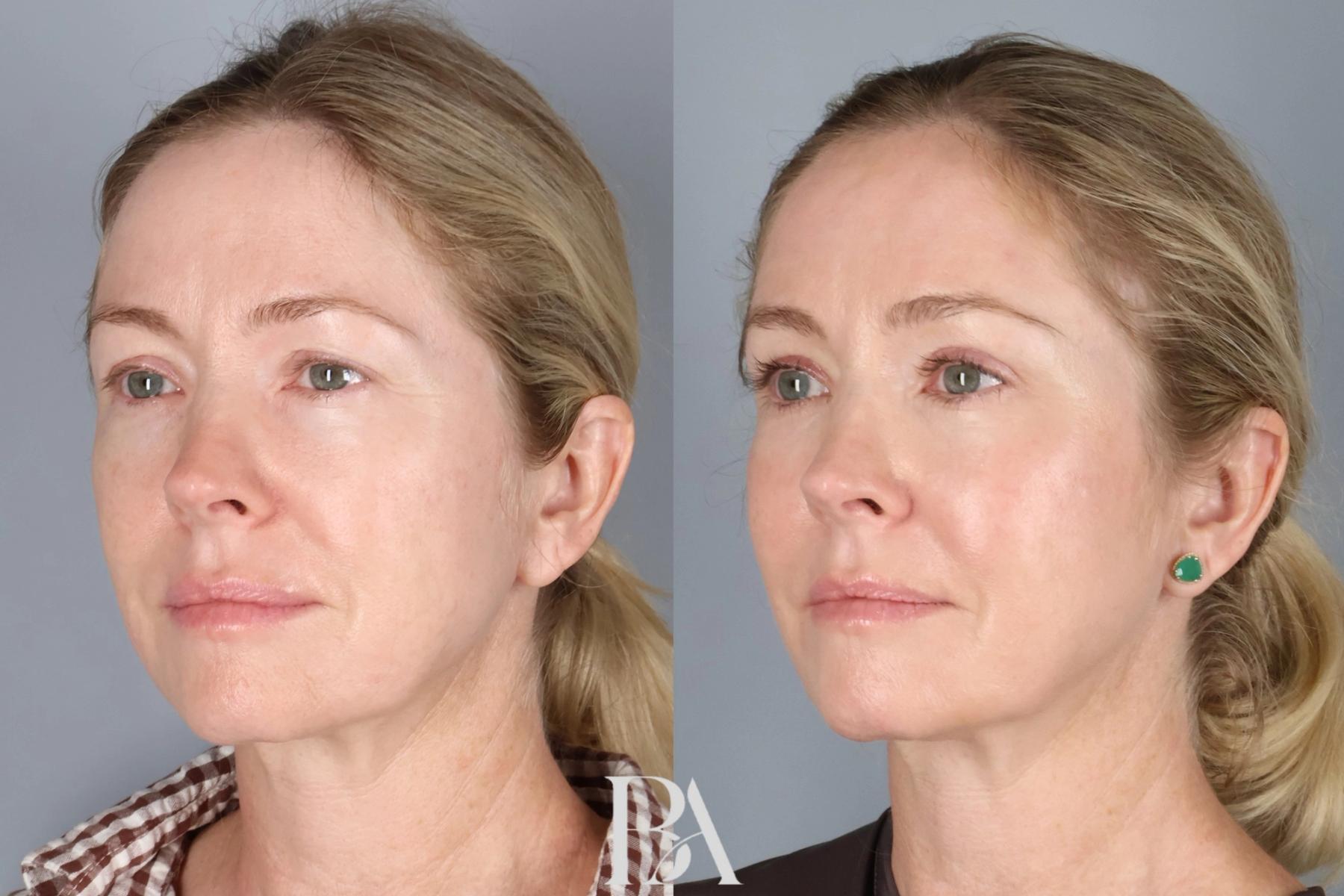 Upper Blepharoplasty before and after — three-quarter view, Dr. Beina Azadgoli, Beverly Hills